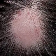 Alopecia - pierderea parului
