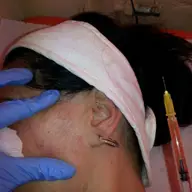 Terapia PRP - Terapia de regenerare a pielii cu plasma proprie