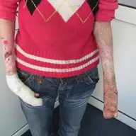 Apel umanitar: Oana sufera de o maladie rara care ii macina pielea si oasele