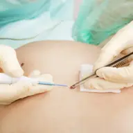 Electrocauterizarea
