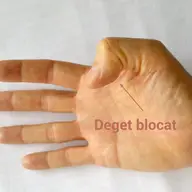 Degetul care se blocheaza