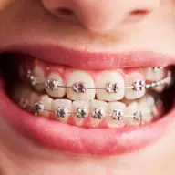 Cât costă un aparat dentar și ce include tratamentul?