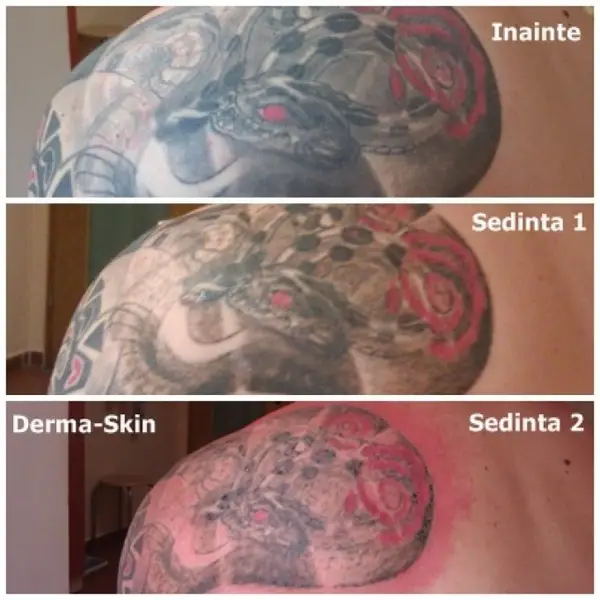 Indepartarea tatuajelor cu laser la Timisoara