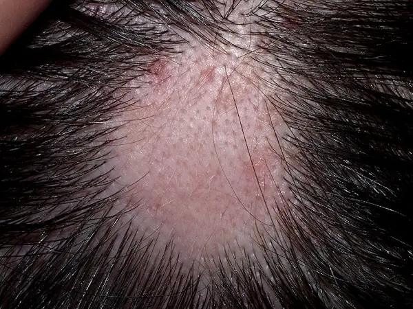 Alopecia - pierderea parului