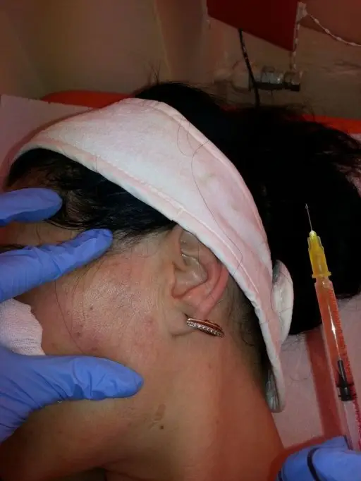 Tera​pia PRP - Terapia de regenerare a pielii cu plasma proprie