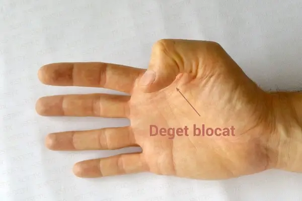 Degetul care se blocheaza