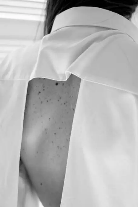 De ce să mergi la un medic dermatolog pentru controlul alunițelor?