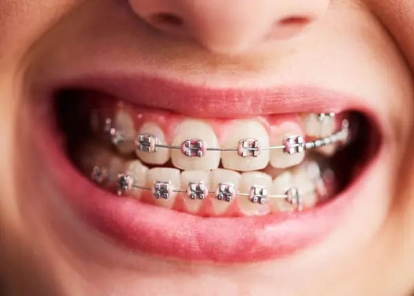 Cât costă un aparat dentar și ce include tratamentul?