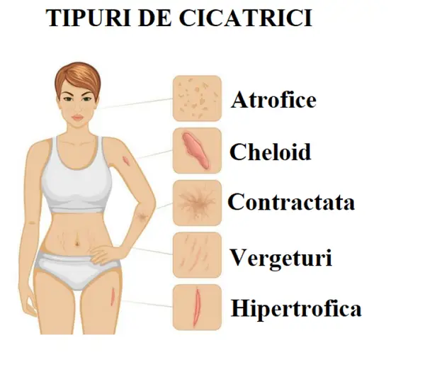 Tipuri de cicatrici și ce soluții de tratament există