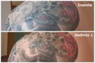 Indepartarea tatuajelor cu laser la Timisoara