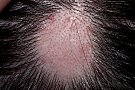 Alopecia - pierderea parului