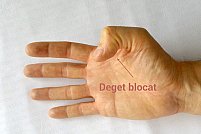 Degetul care se blocheaza